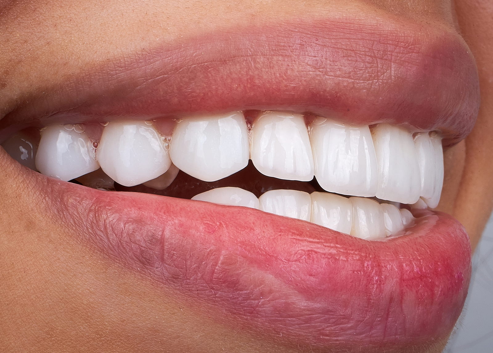 Benefits of dental bonding for natural smile improvement