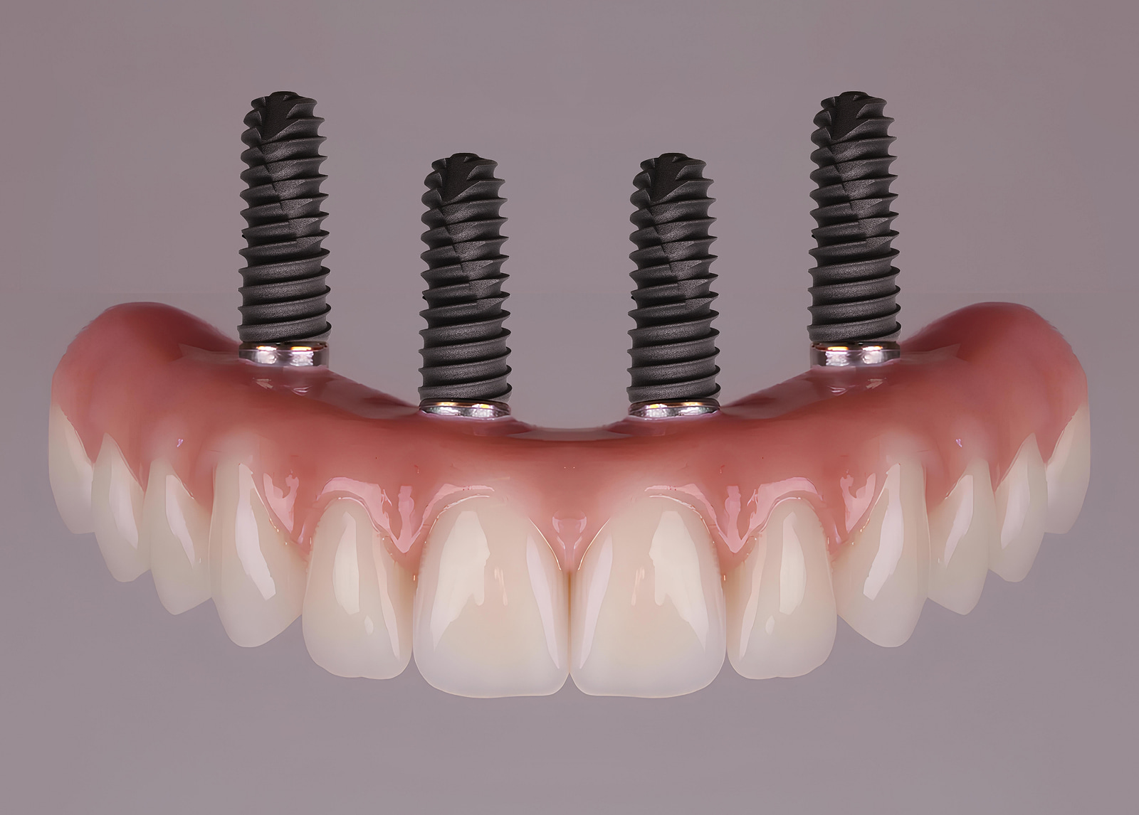 Natural looking and secure full arch dental implant restoration