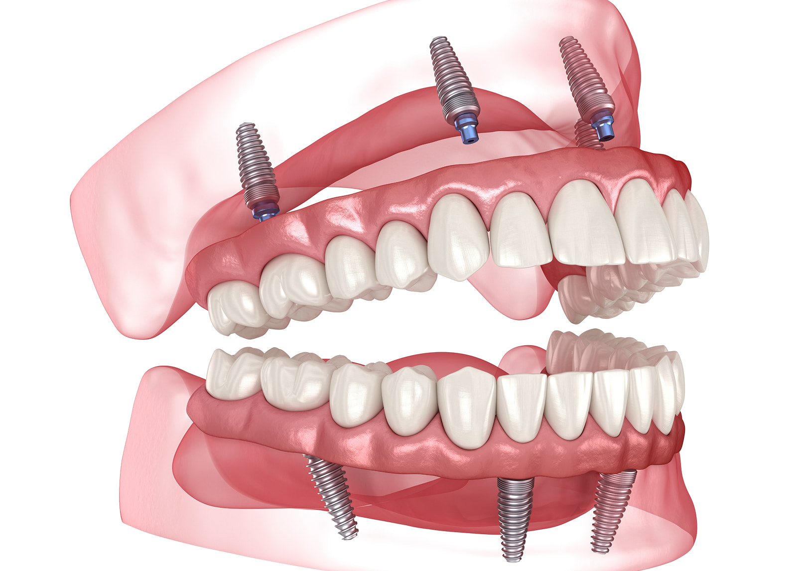 Stable and secure implant supported dentures solution