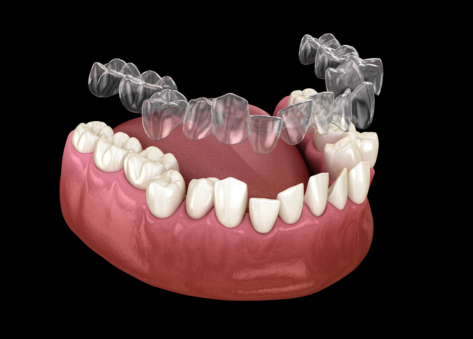 Benefits of Invisalign clear aligners for straight teeth