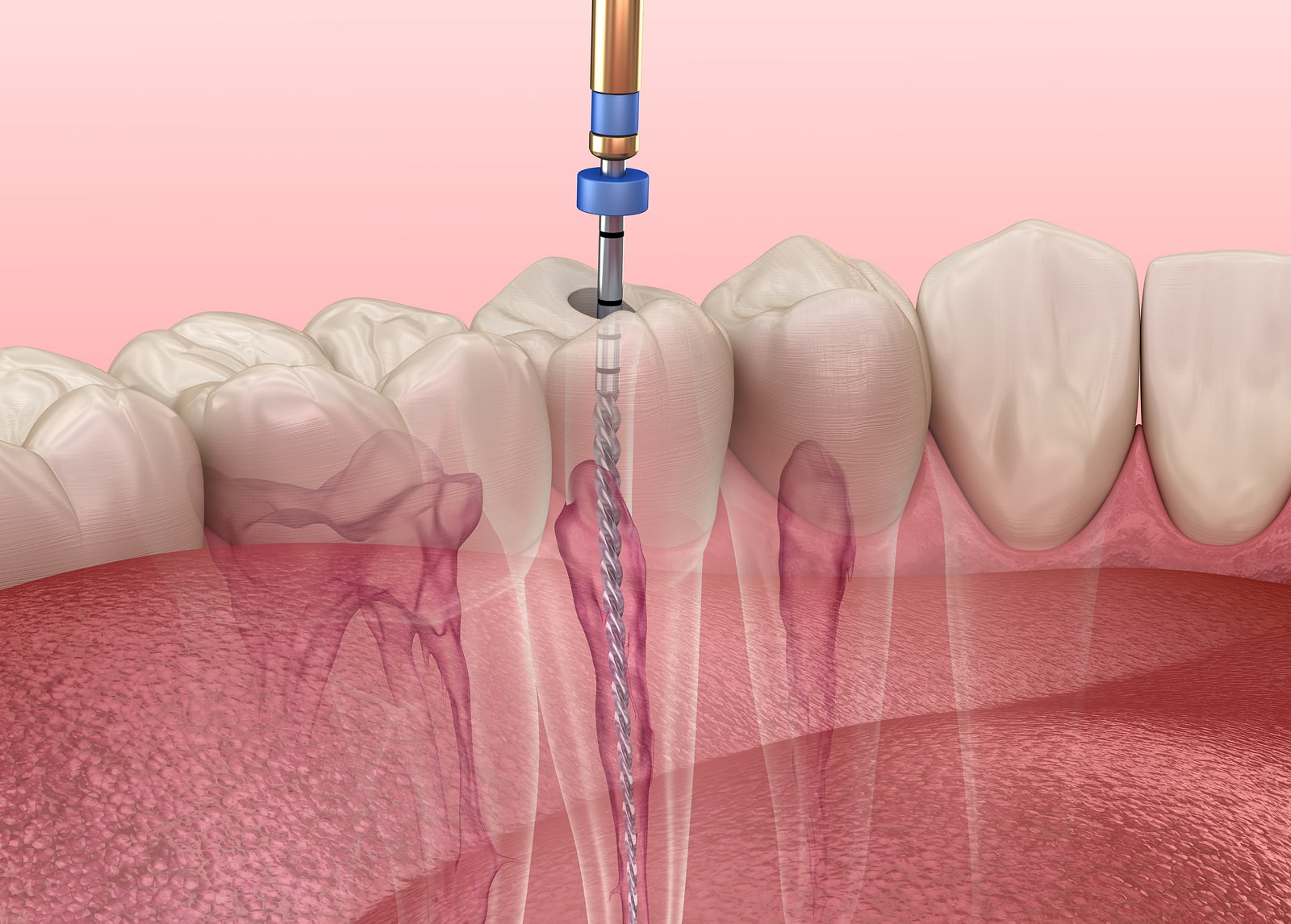 Preserving natural teeth with root canal therapy
