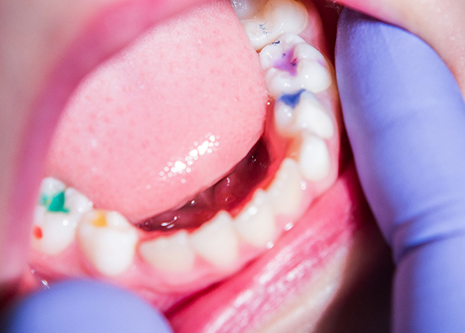 Natural-looking tooth-colored dental fillings