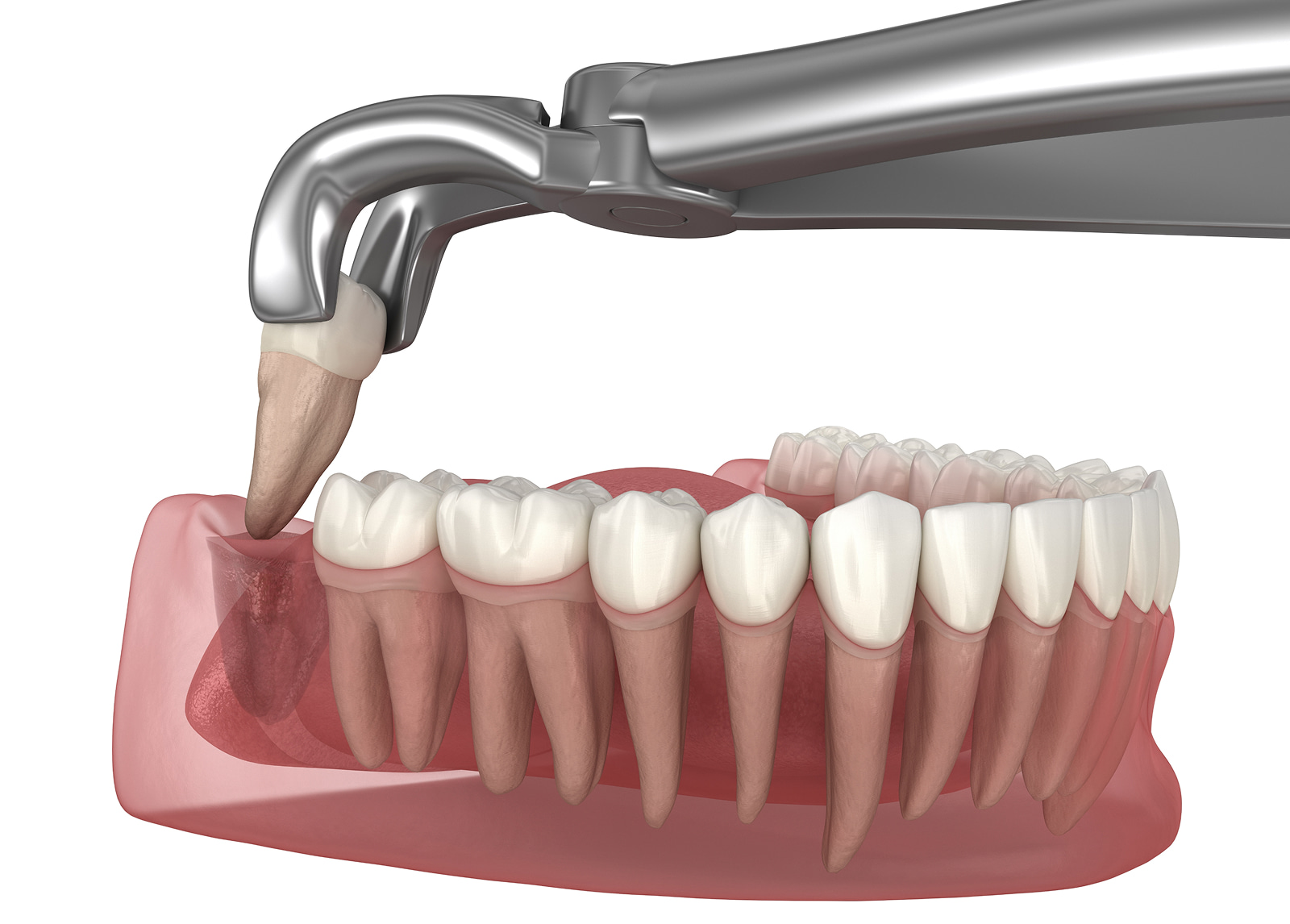 Improved bite and oral health through dental extraction